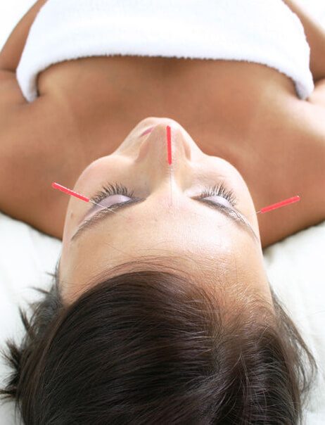 Posturepro Physio Facial Acupuncture Pic