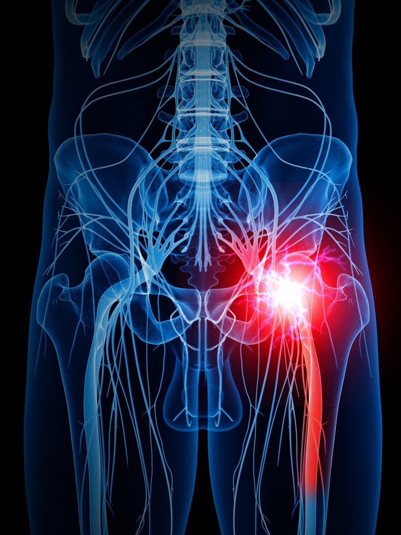 SCIATICA Posturepro Physio