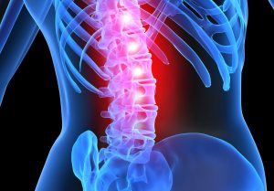 Blown Out Disc Causing Back Pain? - Posturepro Physio