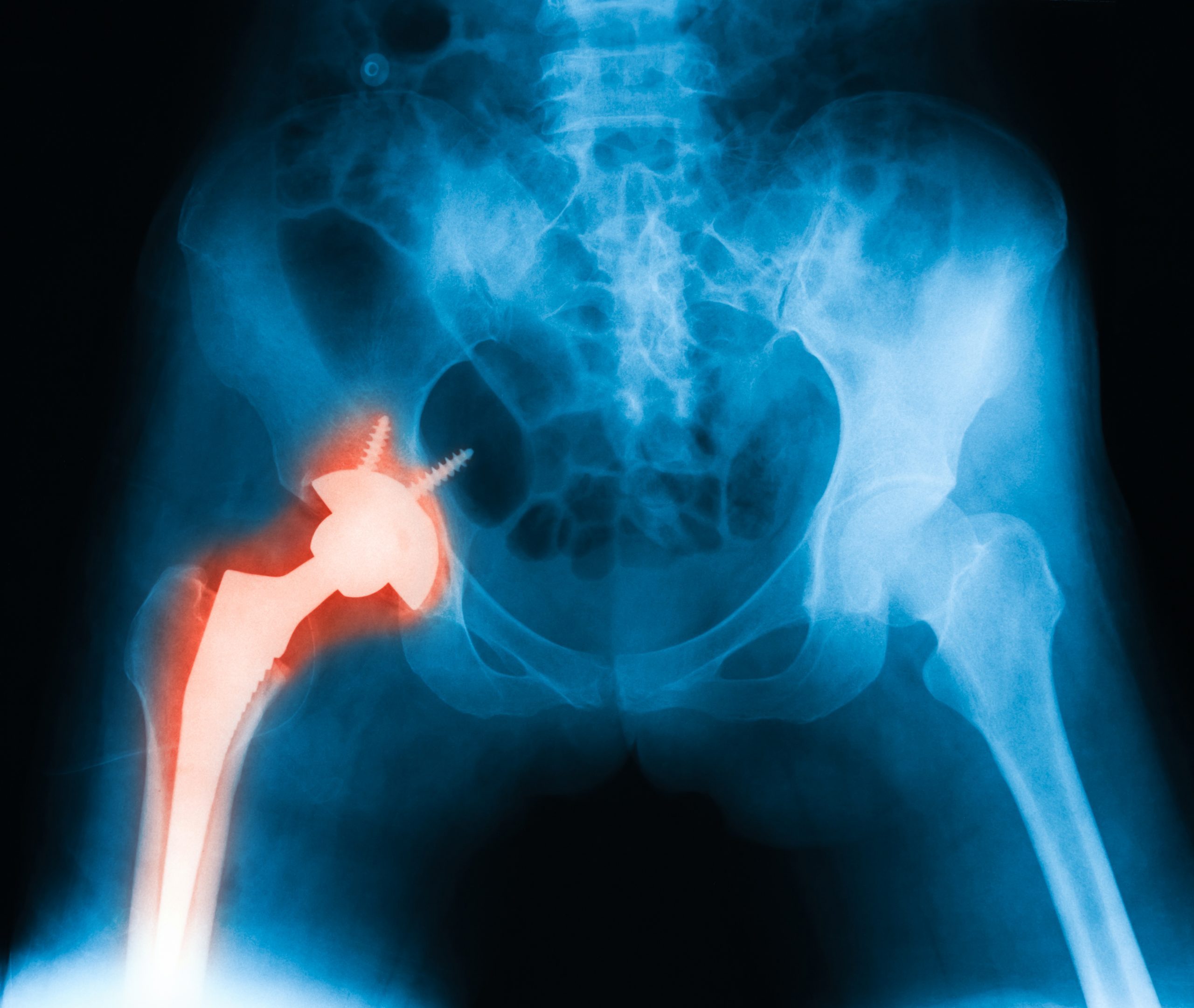 how-to-avoid-a-hip-replacement-posturepro-physio